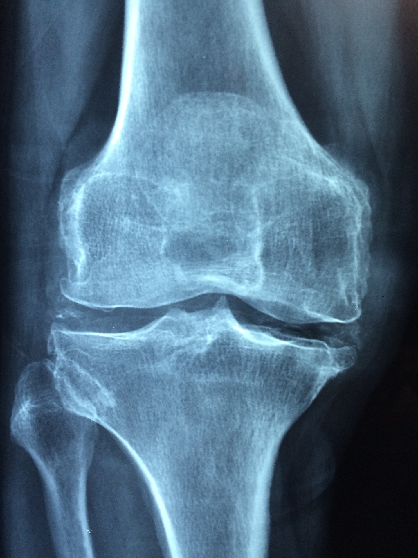 Arthritis Pain Treatments in Singapore